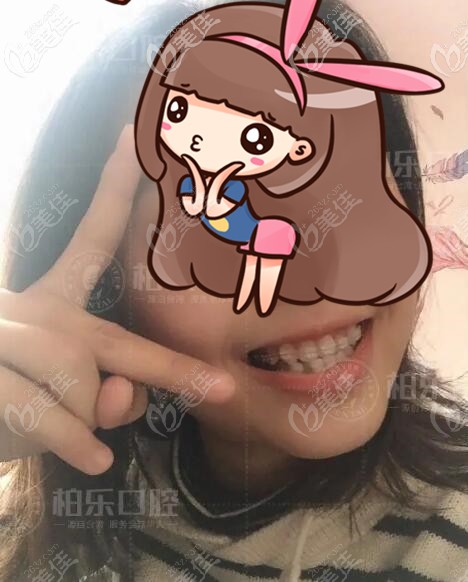 地包天拔牙四顆半隱形陶瓷自鎖正畸8個月,說下南寧柏樂口腔牙齒矯正怎么樣