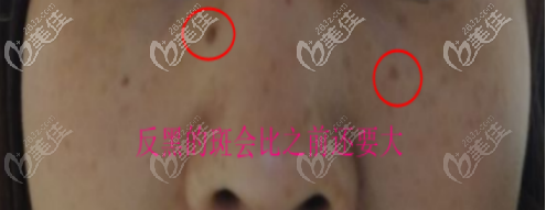 皮秒祛斑后悔了，因?yàn)榉春诘膱D片