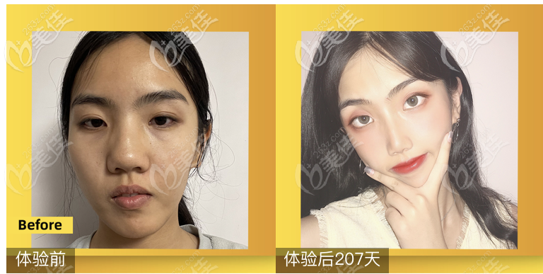 <!--<i data=20240703-sp></i>-->鄒進進醫(yī)生膨體隆鼻案例效果圖 <!--<i data=20240703-sp></i>-->鄒進進醫(yī)生膨體隆鼻案例效果圖