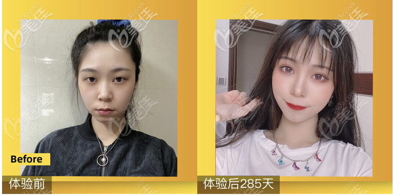 <!--<i data=20240703-sp></i>-->鄒進進醫(yī)生做雙眼皮怎么樣 <!--<i data=20240703-sp></i>-->鄒進進醫(yī)生做雙眼皮怎么樣