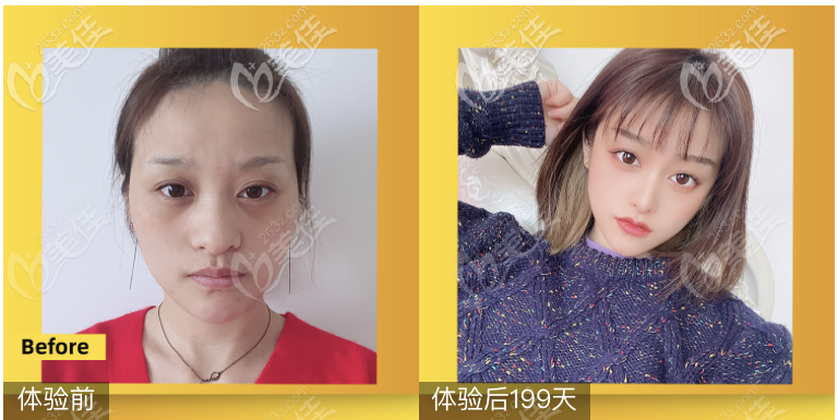 <!--<i data=20240703-sp></i>-->醫(yī)院鄒進進醫(yī)生假體隆鼻案例 <!--<i data=20240703-sp></i>-->醫(yī)院鄒進進醫(yī)生假體隆鼻案例