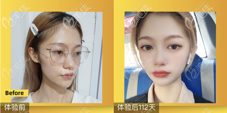 <!--<i data=20240703-sp></i>-->鄒進進隆鼻技術(shù)怎么樣 <!--<i data=20240703-sp></i>-->鄒進進隆鼻技術(shù)怎么樣