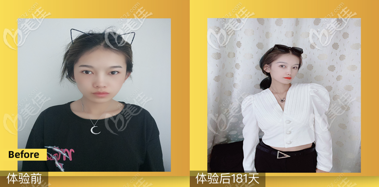 醫(yī)院鄒進(jìn)進(jìn)醫(yī)生怎么樣?對(duì)照鄒進(jìn)進(jìn)醫(yī)生的整形案例了解技術(shù)