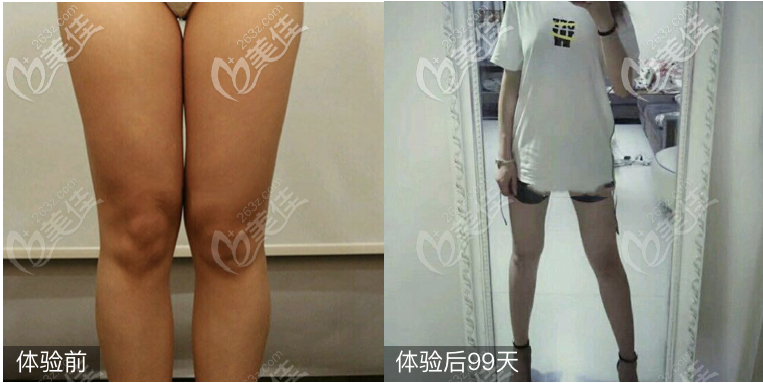 深圳整形醫(yī)生袁野怎么樣?吸脂技術(shù)杠杠的評(píng)價(jià)也超好