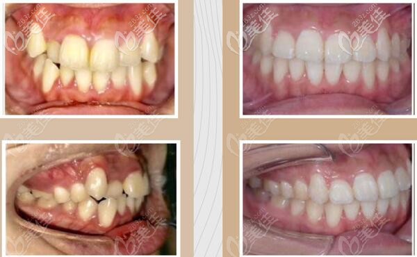 北京諾美口腔虎牙擁擠排列不齊矯正前后照片 北京諾美口腔虎牙擁擠排列不齊矯正前后照片