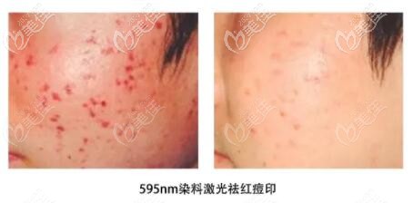 595nm脈沖染料激光去紅痘印 595nm脈沖染料激光去紅痘印