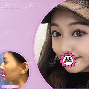 蘇州康美隆鼻案例