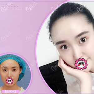 蘇州康美雙眼皮案例