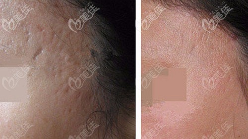 CO2點(diǎn)陣激光去疤案例圖