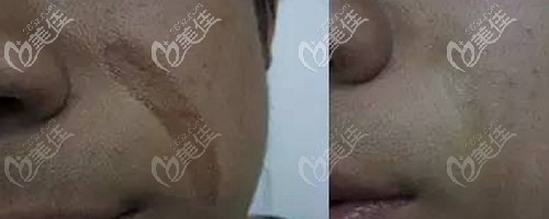 色素性疤痕如何治療