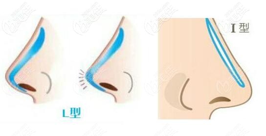 硅膠L型和I型假體哪個更安全 硅膠L型和I型假體哪個更安全