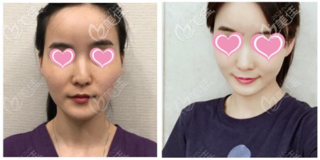 黃金微雕加脂肪填充效果 黃金微雕加脂肪填充效果