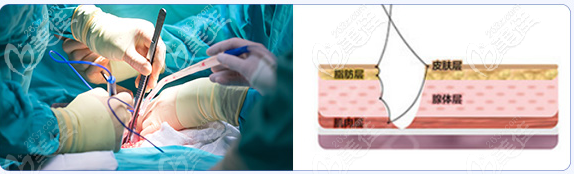 <!--<i data=20240703-sp></i>-->醫(yī)院陳星光隆胸手術(shù)過(guò)程 <!--<i data=20240703-sp></i>-->醫(yī)院陳星光隆胸手術(shù)過(guò)程