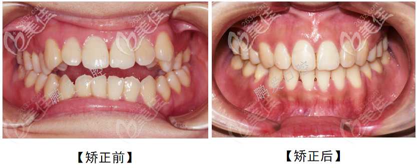 廣州博愛口腔門診部開頜牙齒矯正案例