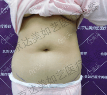 我做腰腹吸脂前 我做腰腹吸脂前