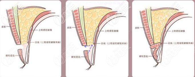 寧波壹加壹林勇雙眼皮優(yōu)勢