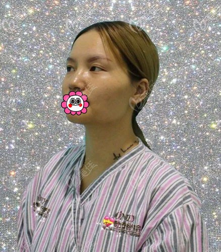 到寧波壹加壹做隆鼻前 到寧波壹加壹做隆鼻前