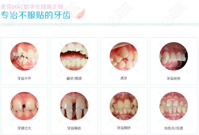 深圳麥芽口腔牙齒矯正多少錢