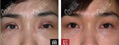 廣州美恩許揚(yáng)濱雙眼皮修復(fù)案例 廣州美恩許揚(yáng)濱雙眼皮修復(fù)案例