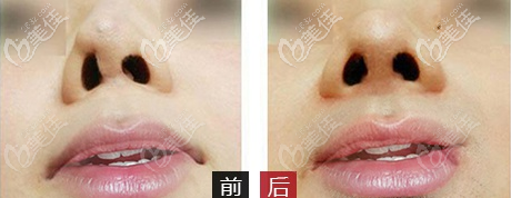 廣州美恩許揚(yáng)濱鼻子修復(fù)案例 廣州美恩許揚(yáng)濱鼻子修復(fù)案例