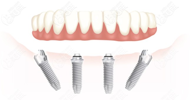 Allon4種植牙技術(shù)