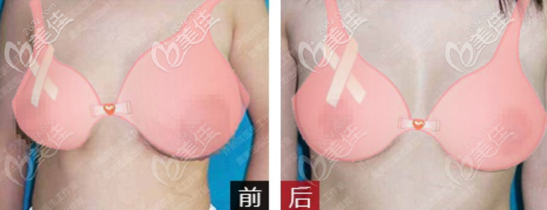 廣州美恩許揚(yáng)濱胸部乳房奧美定取出案例 廣州美恩許揚(yáng)濱胸部乳房奧美定取出案例