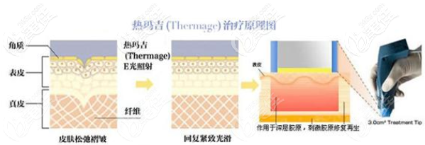 熱瑪吉作用原理示意圖