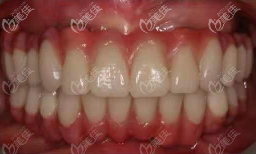 做烤瓷牙失敗后不要慌,看看我做全口種植牙的效果怎么樣吧！