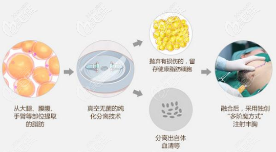自體脂肪豐胸的大致過程