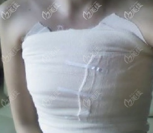 自體脂肪豐胸術(shù)后包扎繃帶