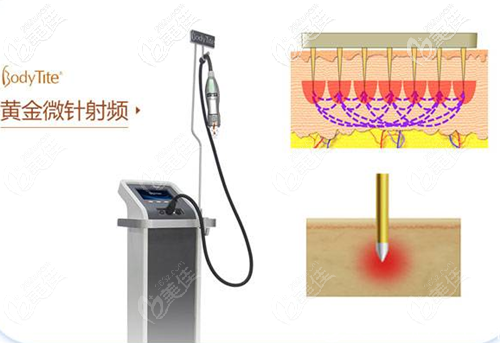 Bodytite黃金微針射頻儀器