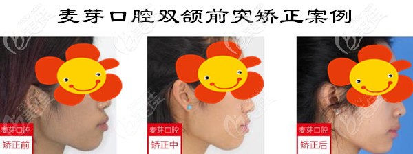 瞧!這是我26歲時(shí)在深圳麥芽口腔做雙頜前突矯正的對(duì)比照哦