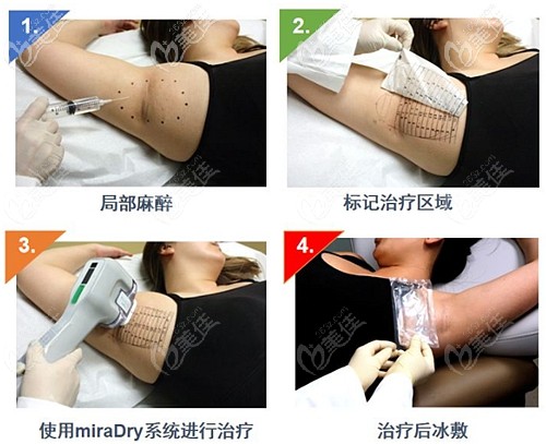 miradry微波治療腋臭的過程