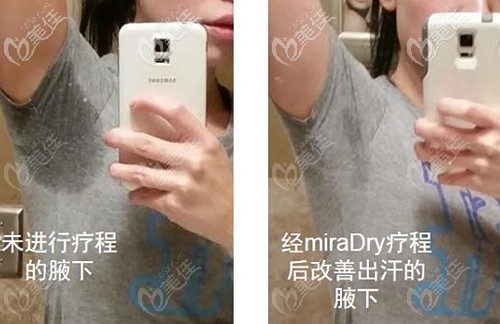 miradry微波治療腋臭的療效