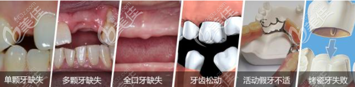 種植牙適應(yīng)人群