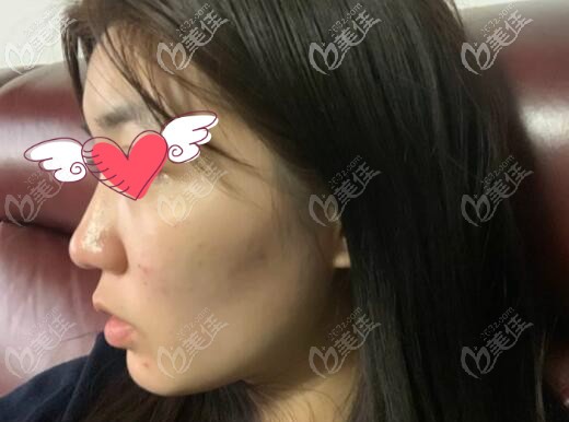 我骨性凸嘴戴牙套正畸2年后沒用,花十萬做正頜手術(shù)才恢復正常面型!