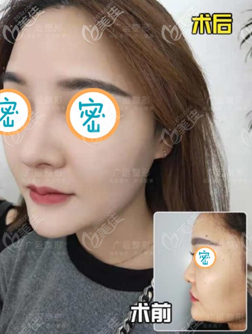 <!--<i data=20240703-sp></i>-->隆鼻案例 <!--<i data=20240703-sp></i>-->隆鼻案例