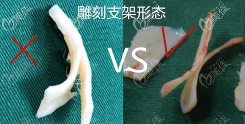 <!--<i data=20240703-sp></i>-->做肋骨鼻的優(yōu)勢 <!--<i data=20240703-sp></i>-->做肋骨鼻的優(yōu)勢