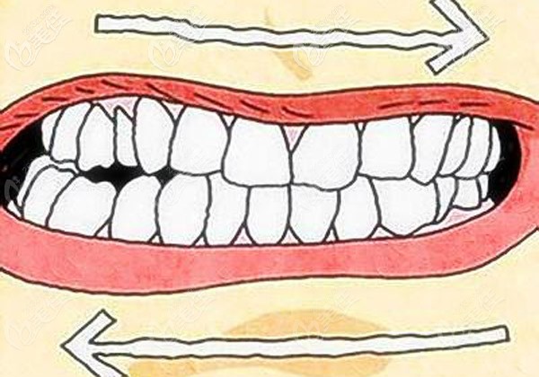 好奇矯正醫(yī)生為啥總建議磨牙后移