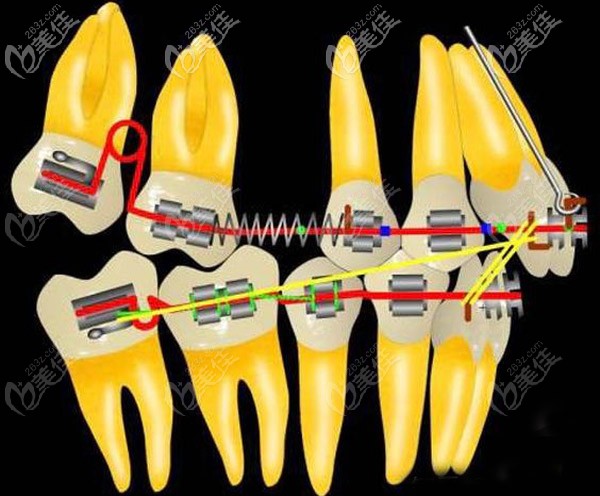 磨牙遠移對臉型的影響（改善）大不