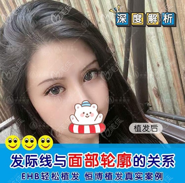 成都恒博EHB植發(fā)技術(shù)真實(shí)案例:高發(fā)際線在植發(fā)后還能改善面部輪廓