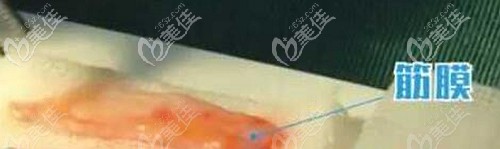 自體筋膜臥蠶能吸收多少