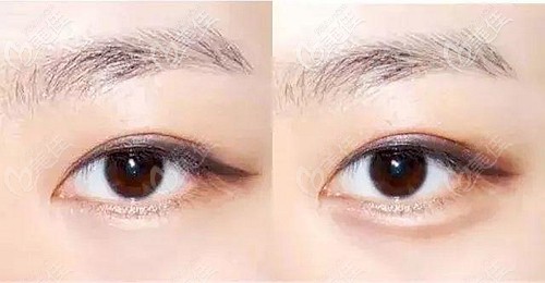 自體筋膜填充臥蠶后的效果