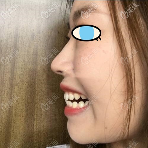 牙齒不齊的圖片 牙齒不齊的圖片