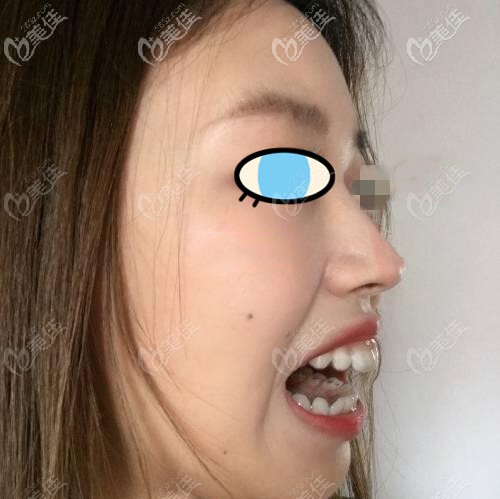 隱適美一個(gè)月后狀態(tài) 隱適美一個(gè)月后狀態(tài)