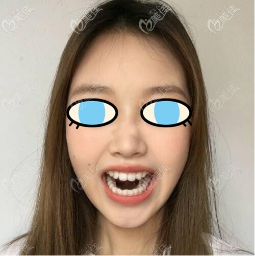 隱適美一個(gè)半月的效果 隱適美一個(gè)半月的效果