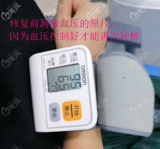 第二次骨粉種植修復(fù)前測(cè)量血壓