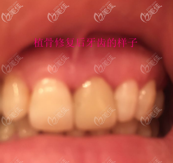 我種植牙8年后牙齒痛還出血，并且牙骨吸收的厲害需要植骨修復(fù)