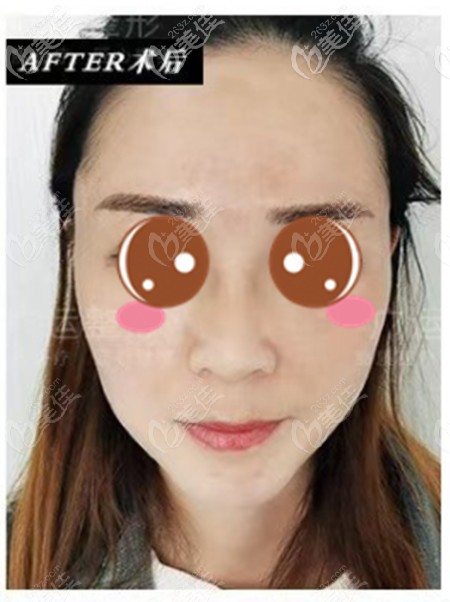 小切口拉皮手術(shù)恢復(fù)圖：沒(méi)點(diǎn)真材實(shí)料，我也不敢說(shuō)做面部提升好呀！