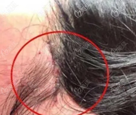 小切口面部提升的優(yōu)勢 小切口面部提升的優(yōu)勢